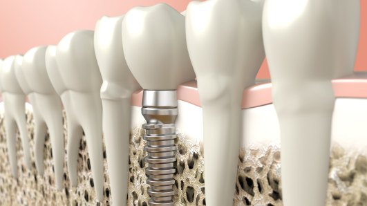 implante-dentario-gde