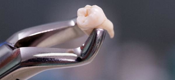 extração-siso-dentista-bh-clinica-odontológica-bh